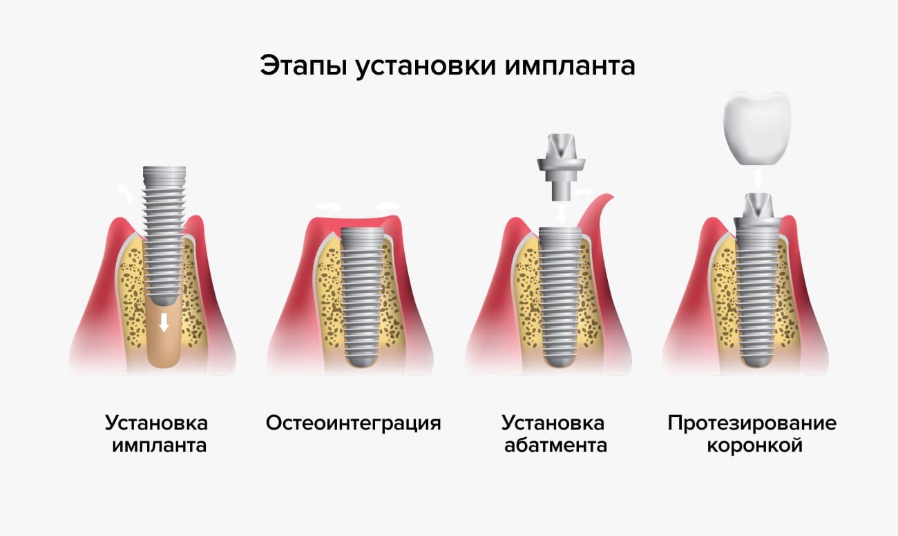 импланты 8